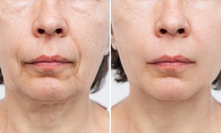 How Long is Recovery from a Facelift? Fort Worth & Arlington